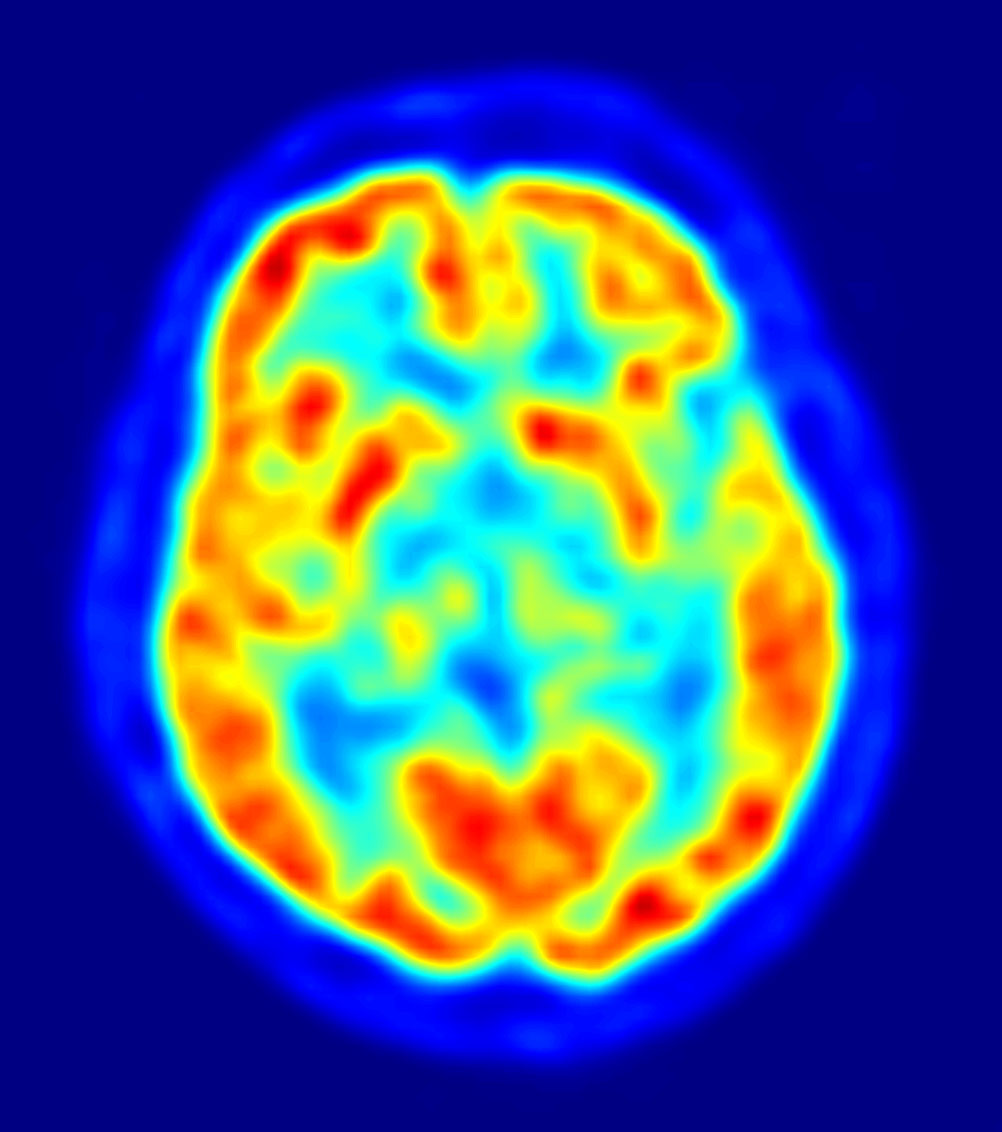 Resetting Balance in Brain’s Reward Centers May Help Treat Alcohol Addiction