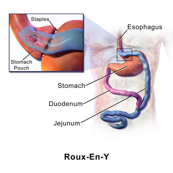Gastric Bypass Surgery Linked to Alcoholism